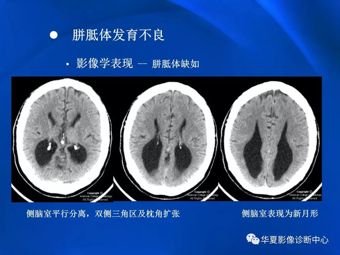 胼胝体病变影像学表现