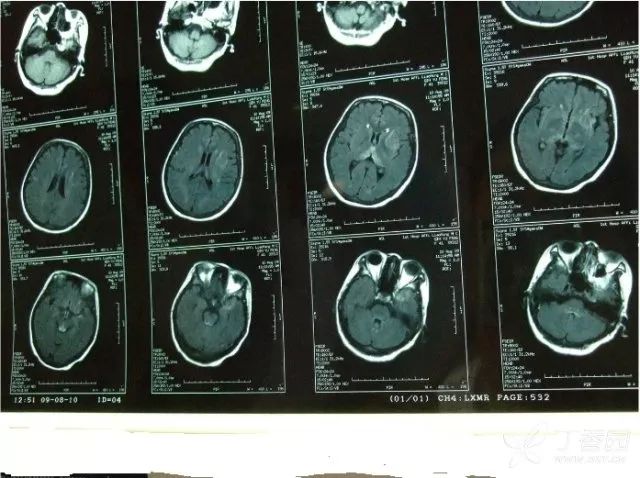 患者脑磁共振图象及相关实验室检查,腰穿结果公布如下