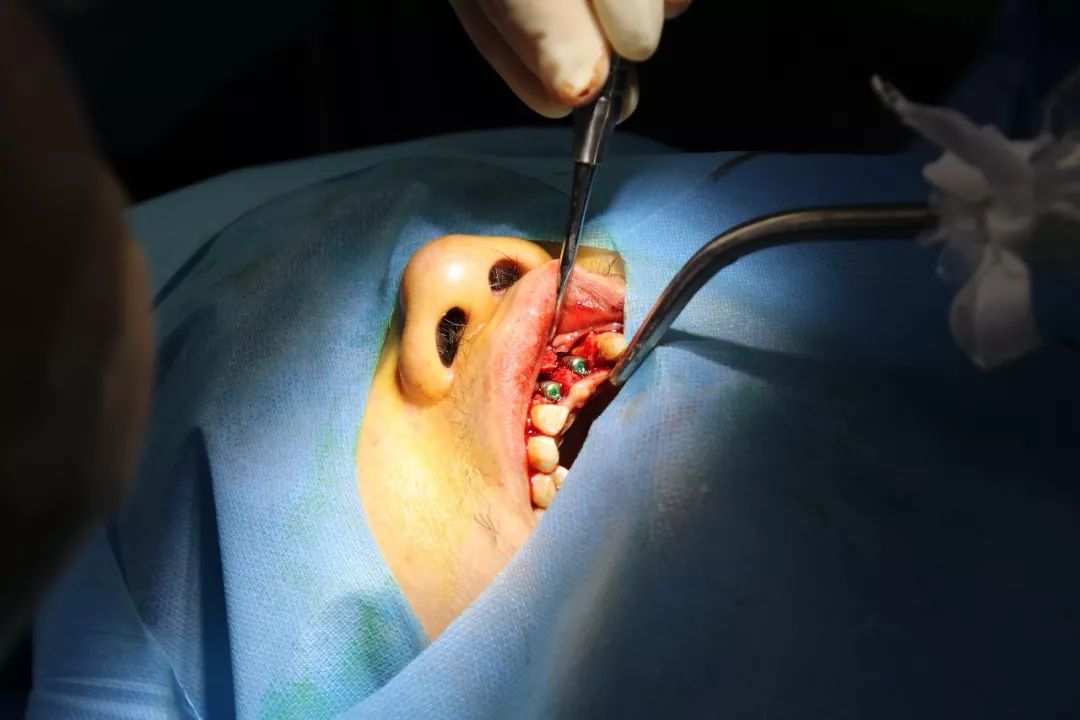 厉害了!我院口腔科成功完成百例人工种植牙手术