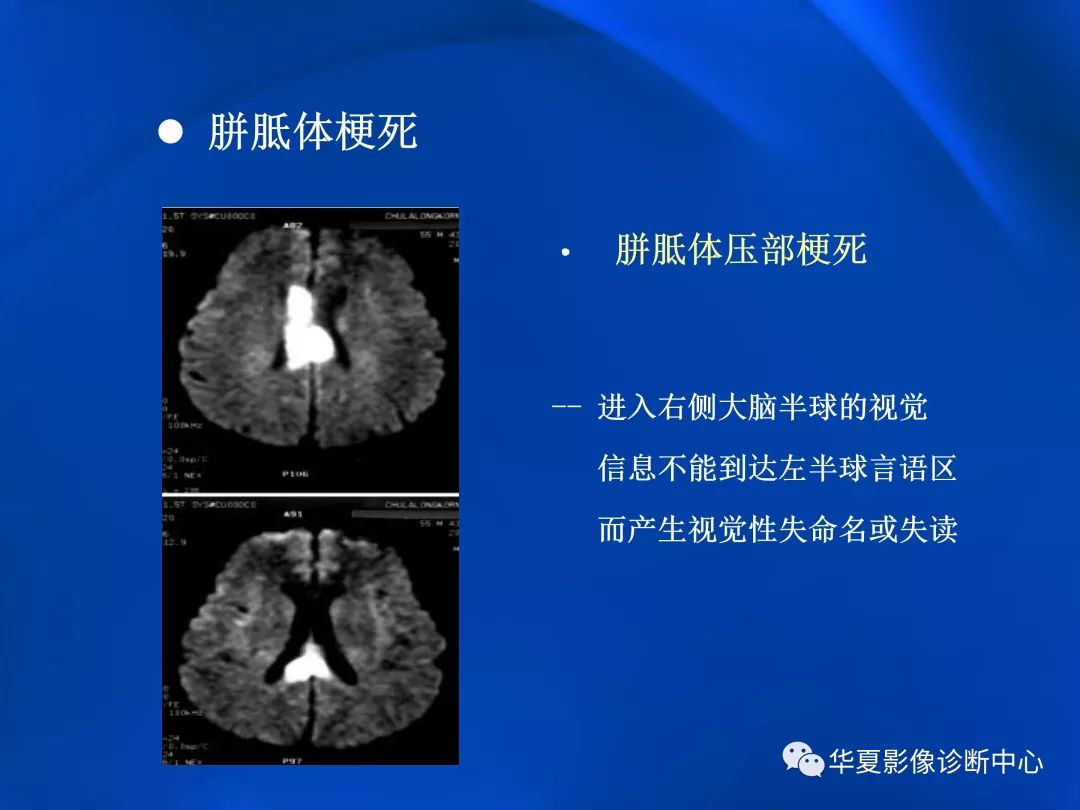 胼胝体病变影像学表现