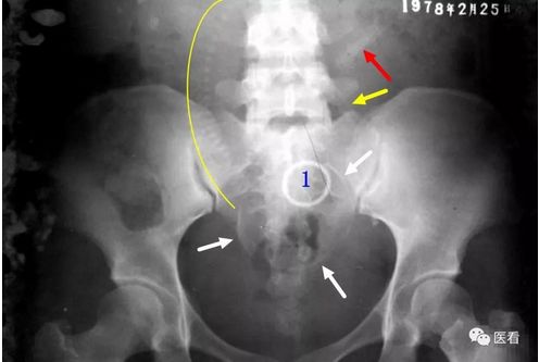 一张很有意思的x光教学片~放射科老主任特意留下来的