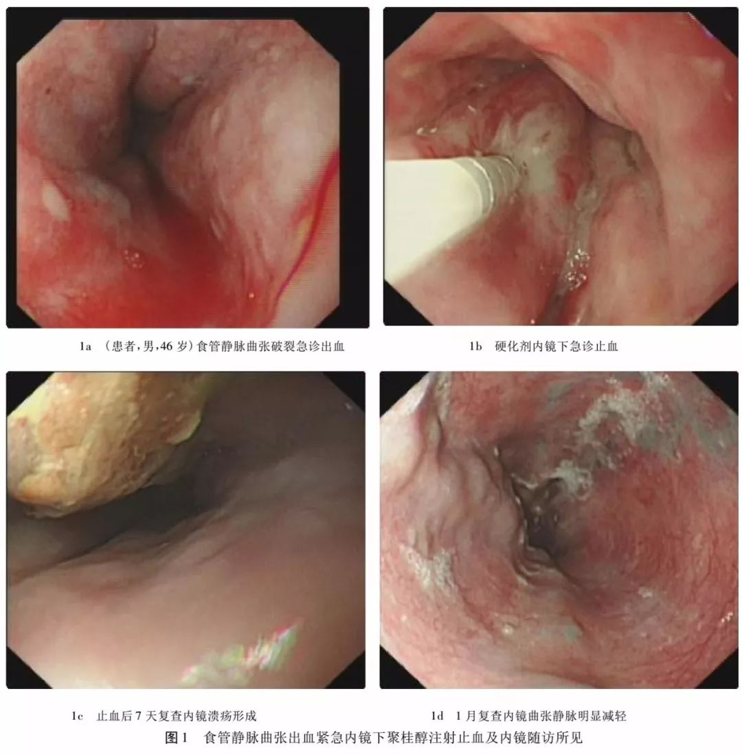 文献推荐 | 内镜下聚桂醇注射治疗食管静脉曲张的临床