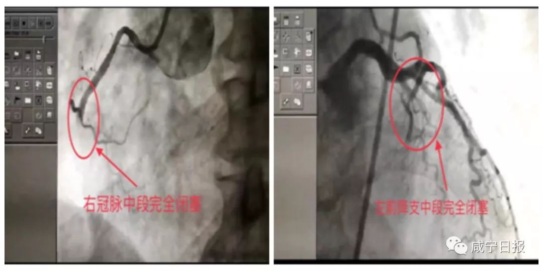 患者冠脉造影结果