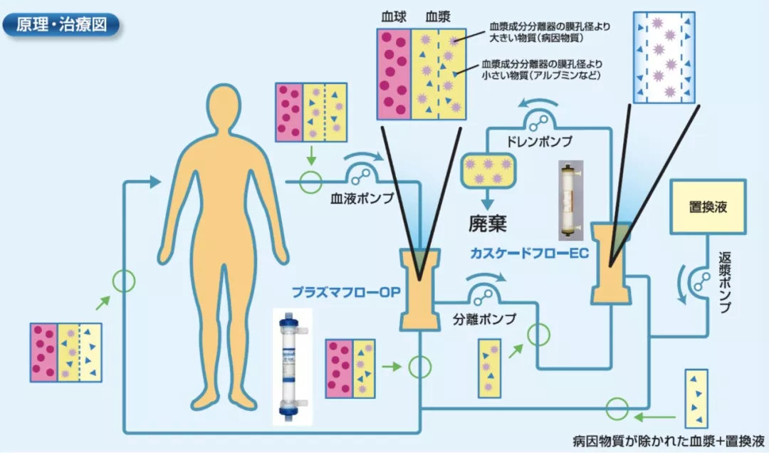 日本高端dfpp疗法血液也需要净化