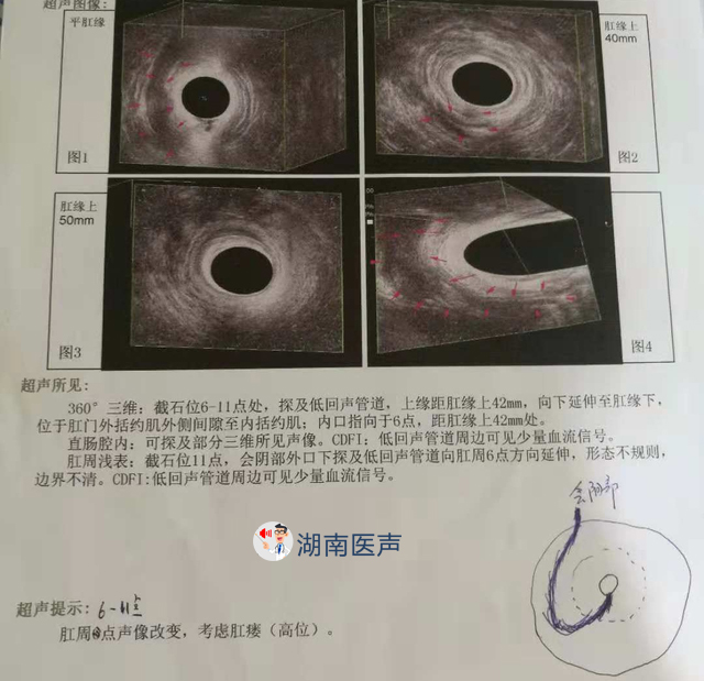 39岁男子15年来肛周反复流脓,小心或是"癌变前兆"!