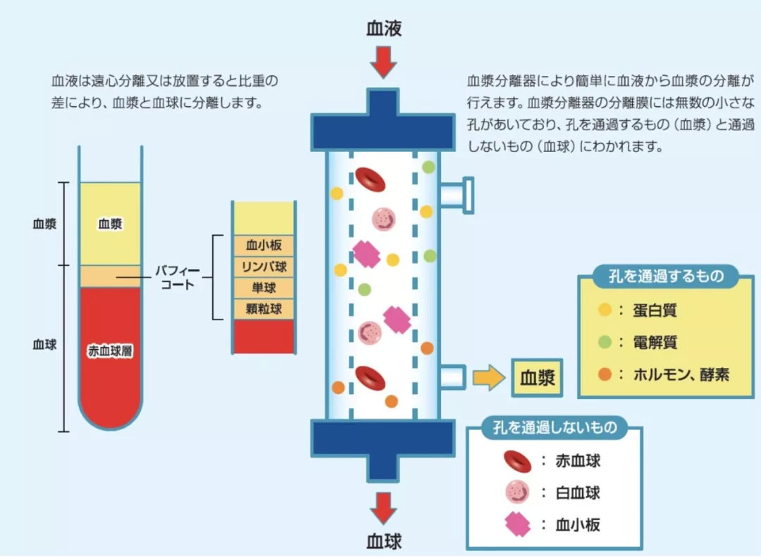 日本高端dfpp疗法血液也需要净化