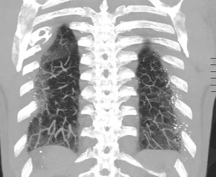 6种弥漫性肺钙化的鉴别诊断