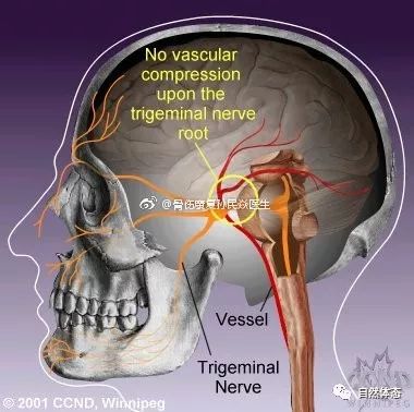 继发性三叉神经痛多见于40岁以下中,青年人,通常没有扳机点,诱发因素