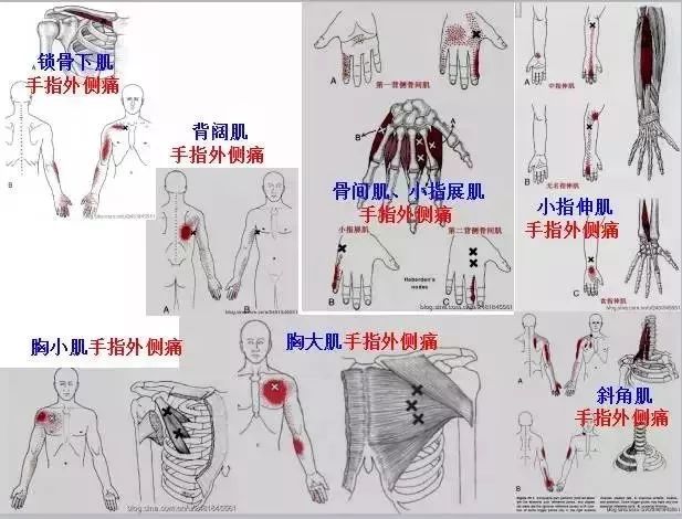 【疼痛康复必备】《全身激痛点手册》肌筋膜疼痛与功能障碍图文全解