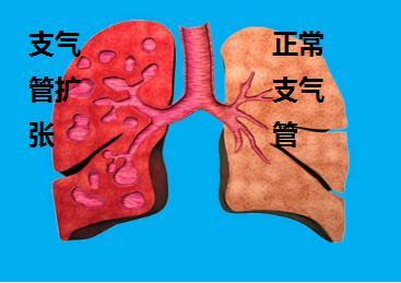 慢性支气管炎,肺气肿是一种什么疾病?年轻人也会患上肺气肿吗?