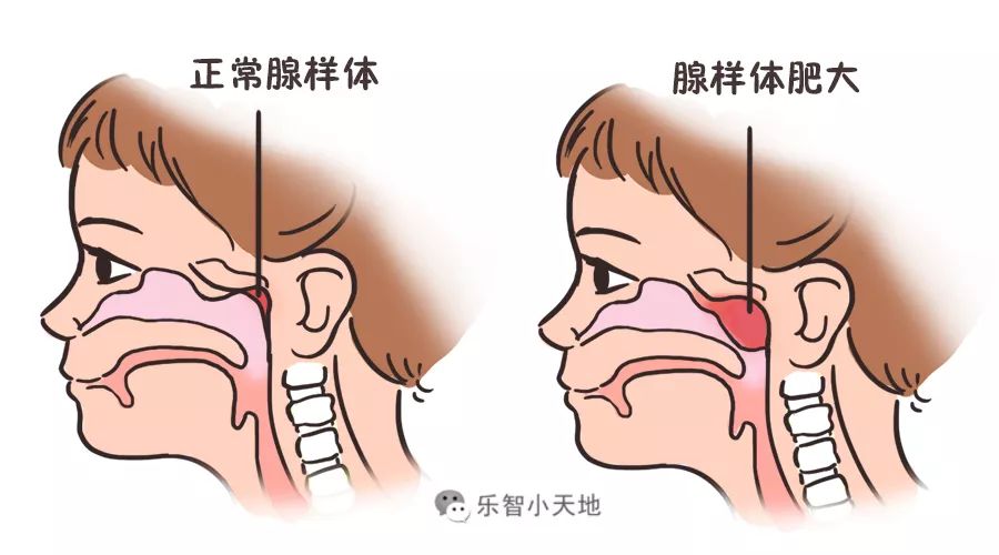 病理性原因除了临床常见的腺样体肥大,还有扁桃体肥大,鼻炎,鼻中隔