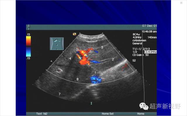 【超声微课堂】肝脏超声扫查