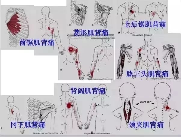 疼痛康复必备全身激痛点手册肌筋膜疼痛与功能障碍图文全解