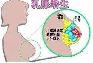 蓝丁格尔专家提醒:患有乳房肿块要高度"警惕"