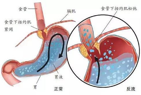 其中,胃与食管交界处抗反流屏障为防止反流的第一道防线,食管下括约肌