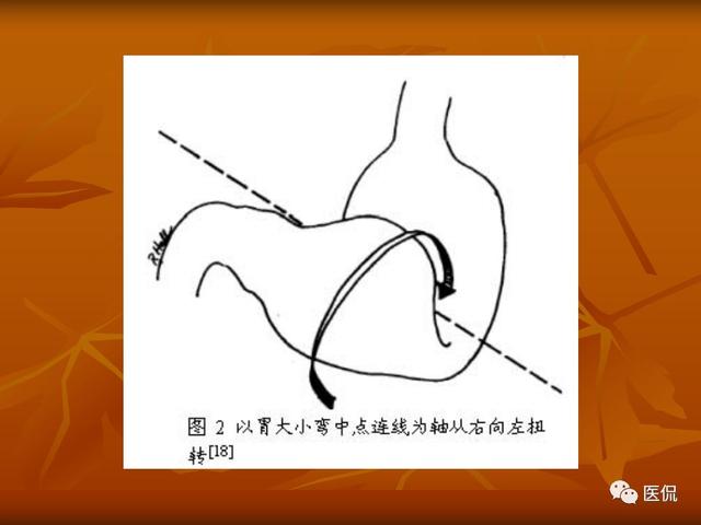 胃扭转的x线诊断与鉴别诊断医学影像经典ppt