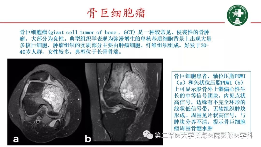 膝关节骨髓水肿的mri影像表现