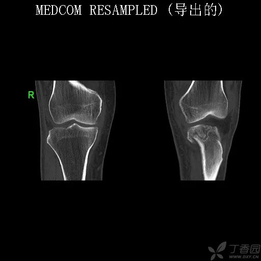 很典型的膝关节间接征象