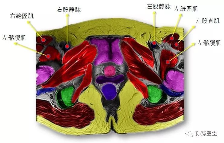 医学笔记锋哥教你读盆腔核磁共振4经女性耻骨联合中份的横断层