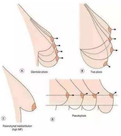 原因嘞?受地心引力的影响,过大的乳房甚至会下垂,影响乳房形态.