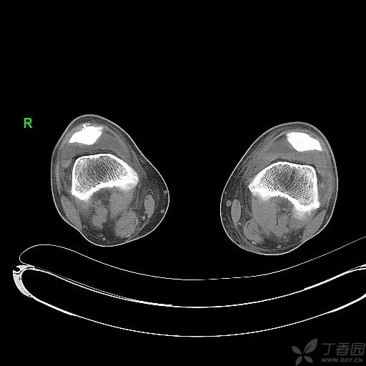 很典型的膝关节间接征象