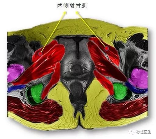 医学笔记锋哥教你读盆腔核磁共振4经女性耻骨联合中份的横断层