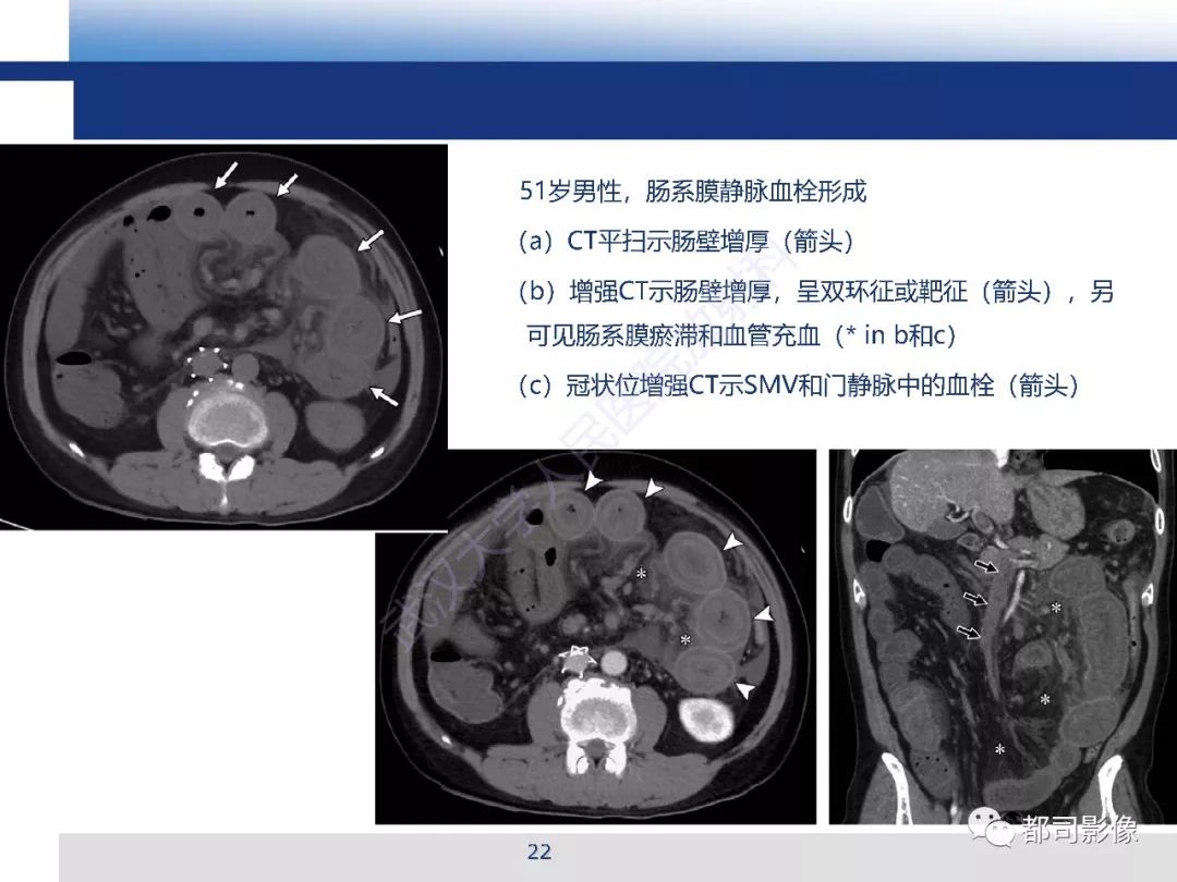 急性肠系膜血管缺血的ct表现及介入治疗