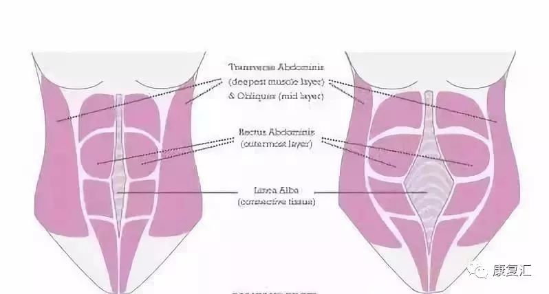 的人都会有腹直肌分离症,其取决于腹直肌鞘是否能稳定腹直肌的位置