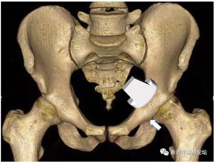 关节囊周神经阻滞在髋关节骨折中的运用_闭孔