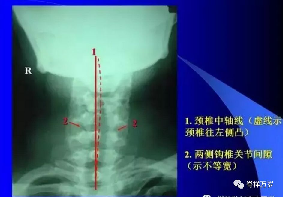 颈椎病x光片解析