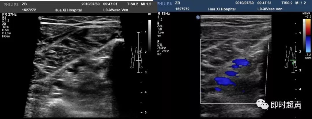 下肢血管超声检查及诊断思路(上)_静脉