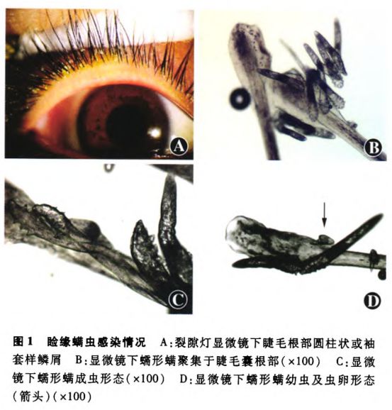 眼睑红肿糜烂,脱屑,睑结膜充血等症状,称为蠕形螨性睑缘炎