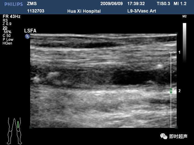下肢血管超声检查及诊断思路上