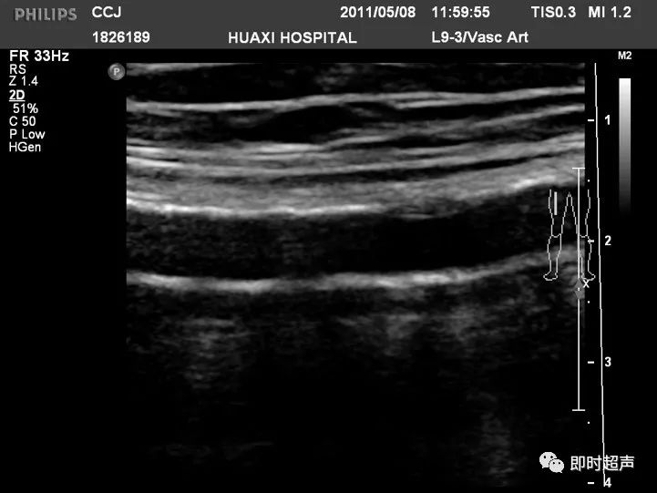 下肢血管超声检查及诊断思路上