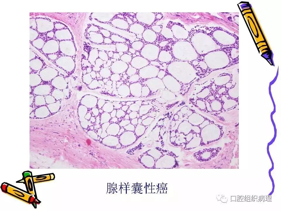 唾液腺肿瘤总论及复习