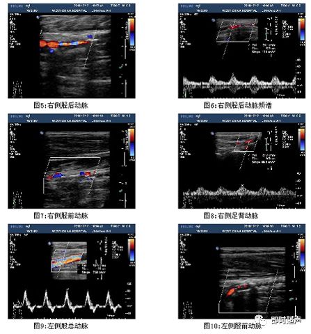 下肢血管超声检查及诊断思路(上)