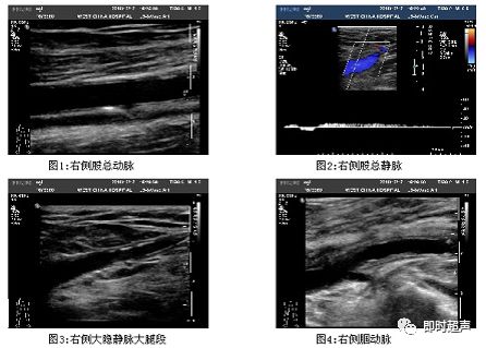 下肢血管超声检查及诊断思路上
