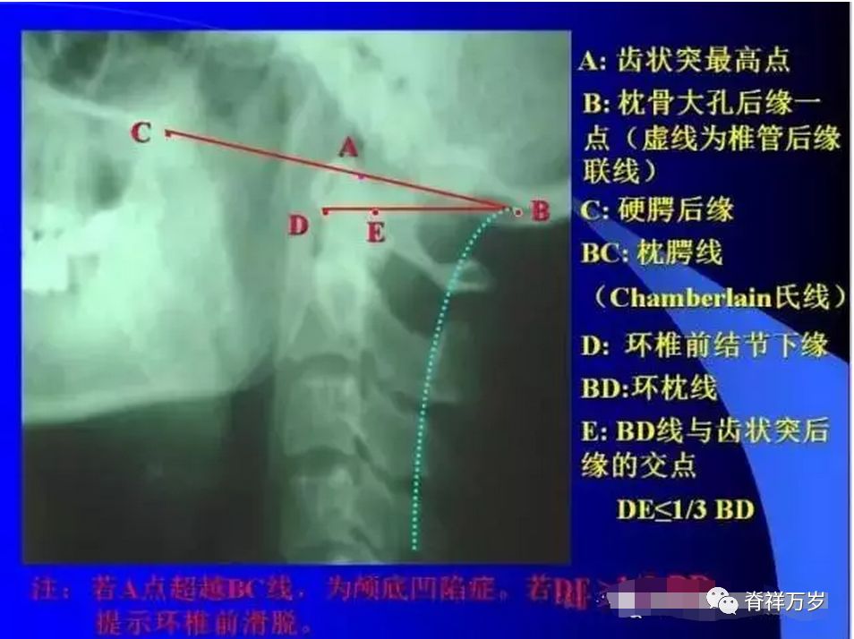 双凹症双边症1颈椎中轴线 2两侧钩椎关节间隙两侧钩椎关节往外侧增生b