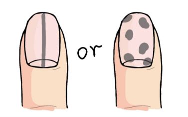 常见于皮肤,足底,足趾,手指末端及甲下等部位,患此病的患者指甲上容易