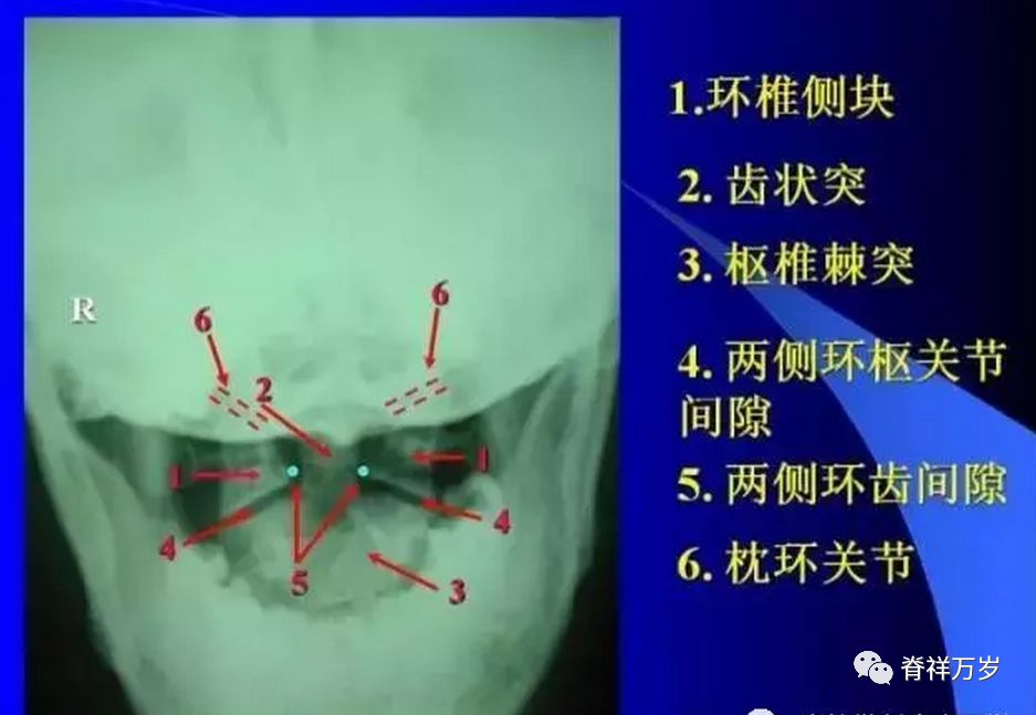 2,齿状突 3,枢椎棘突 4,两侧环枢关节间隙 5,两侧环齿间隙 6,枕环关节