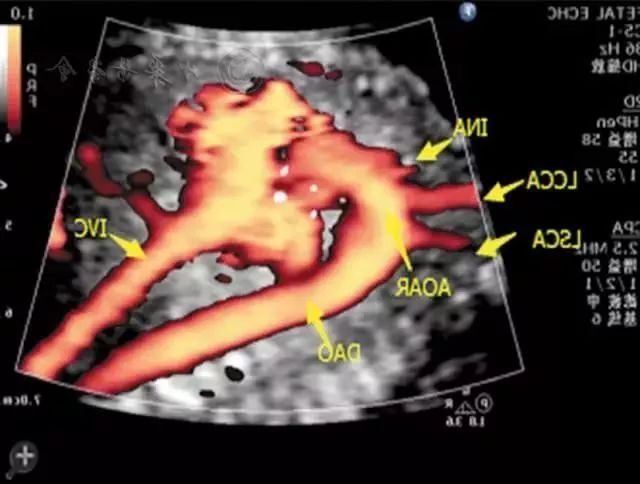 胎儿超声心动图检查必要性!