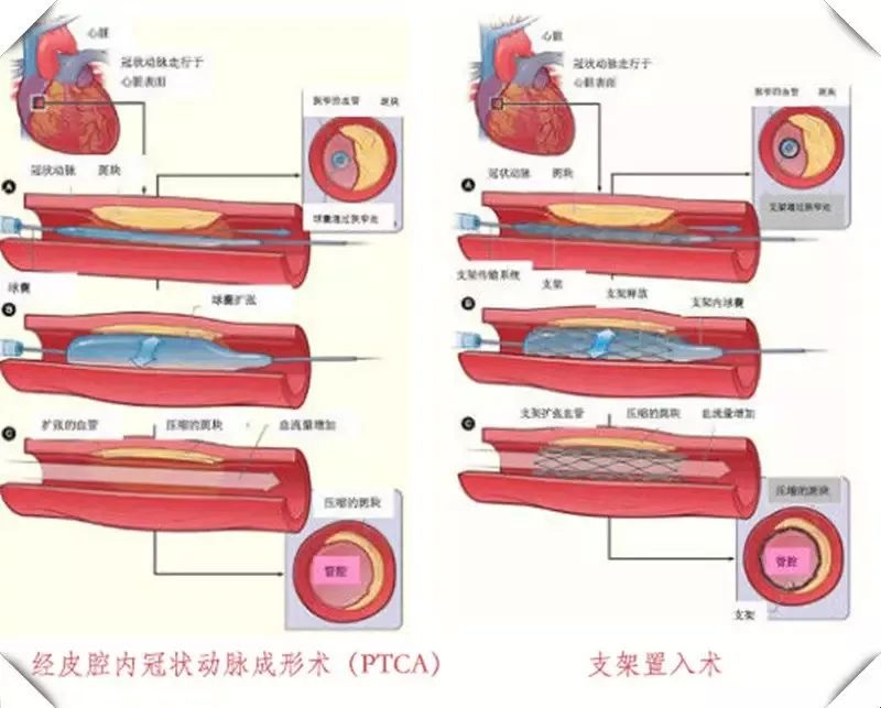 经典总结:心脏介入手术icd-9-cm-3编码探讨