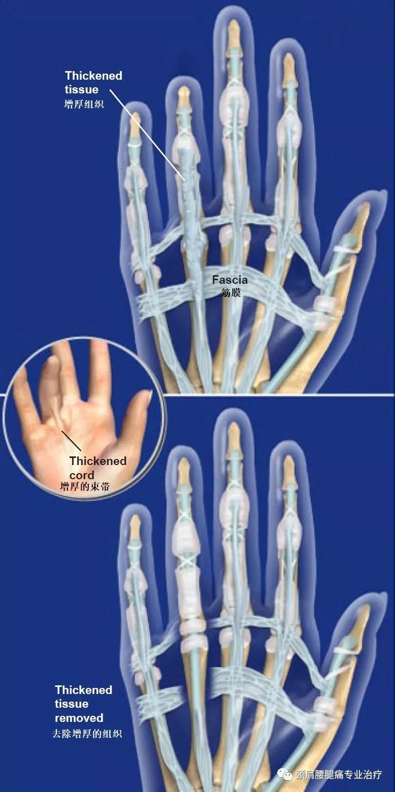 中英文字幕:掌腱膜有限切除术(limited palmar fasciectomy )