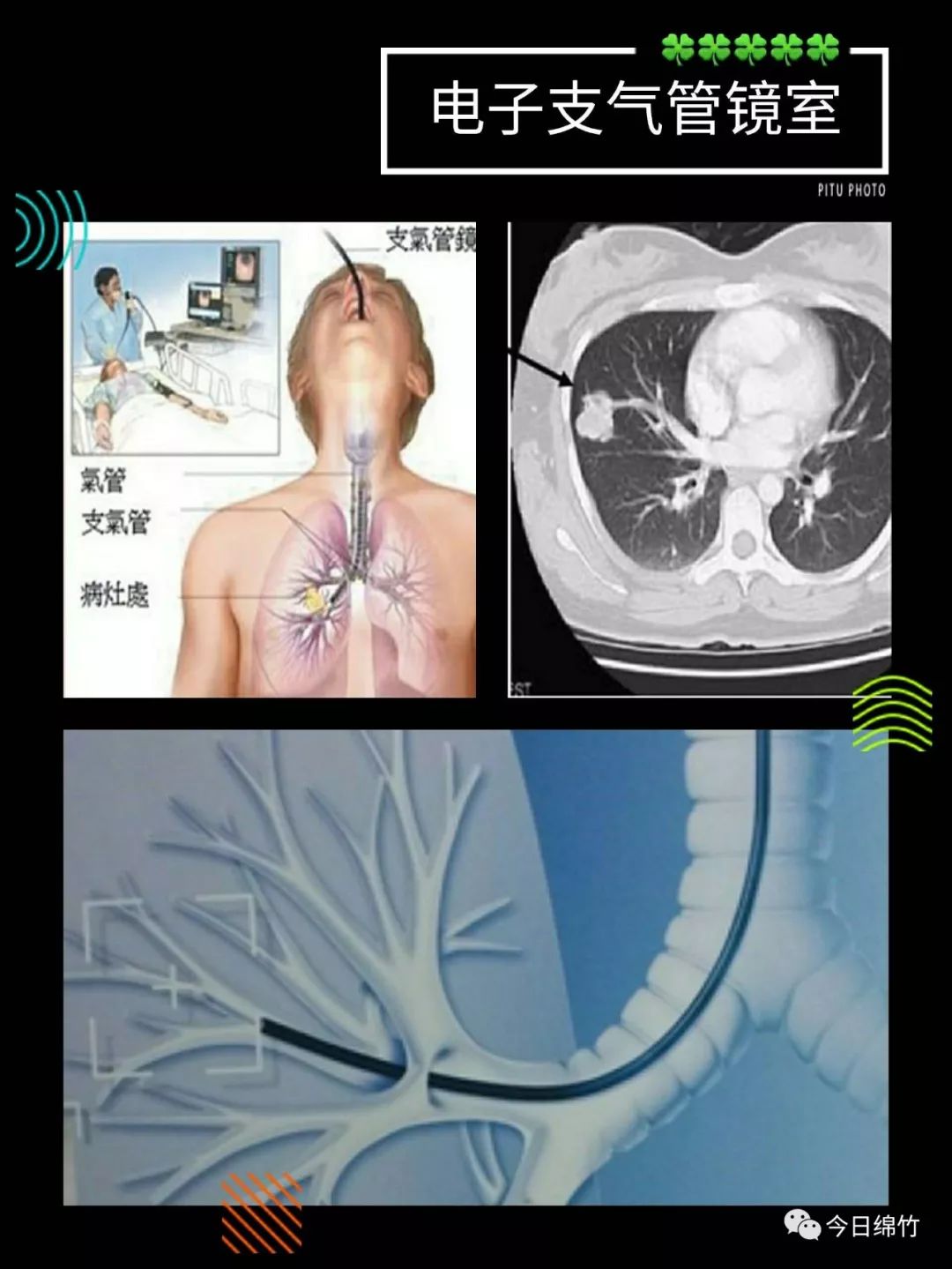 【关注】呼吸道疾病高发季节,华西医院绵竹医院和你聊聊"电子支气管镜