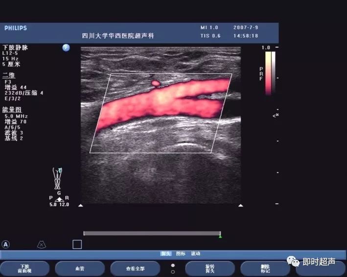 下肢血管超声检查及诊断思路上
