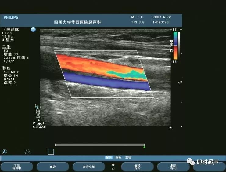 下肢血管超声检查及诊断思路上