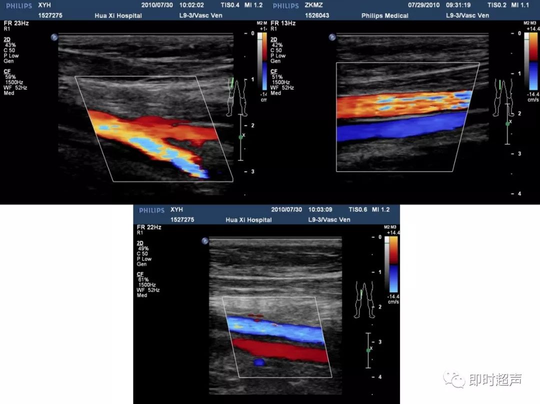 下肢血管超声检查及诊断思路上