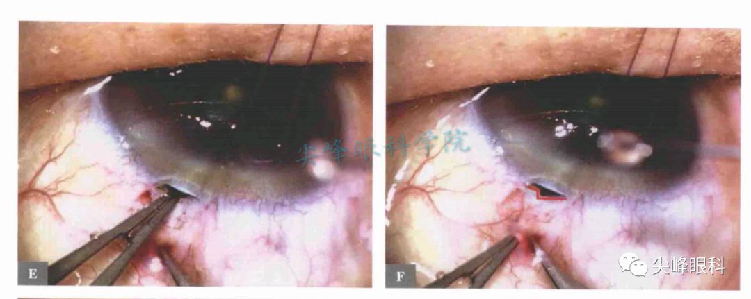 原因: ①切口太后,切口下正对虹膜根部,剪切时很容易引起出血; ②