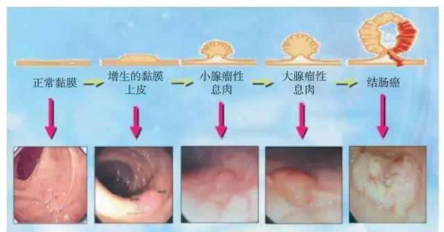 不痛不痒的小疙瘩,可能是直肠瘤噢!