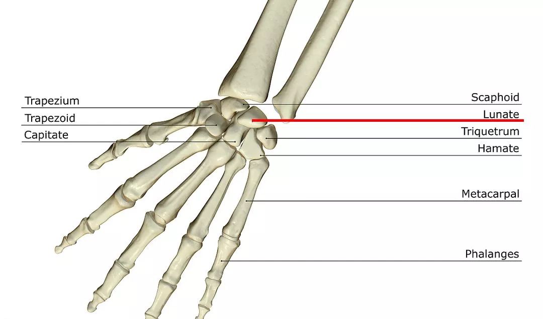 北京中安3d打印个性定制月骨假体